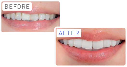ラミネートベニア Before After