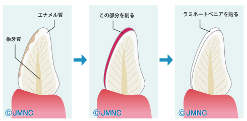 ラミネートベニアの施術イメージ