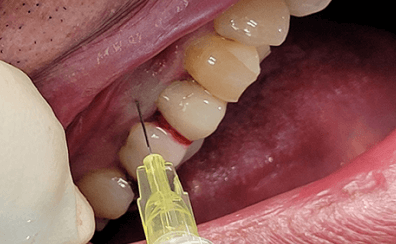 歯周病になっている歯肉に注入し、改善を図っています。